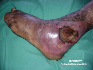 diabetic foot